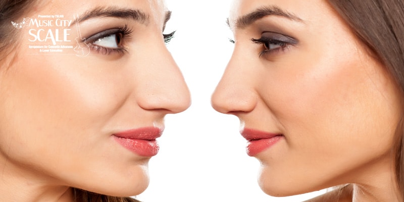 changing-the-shape-of-the-nose-what-are-the-options