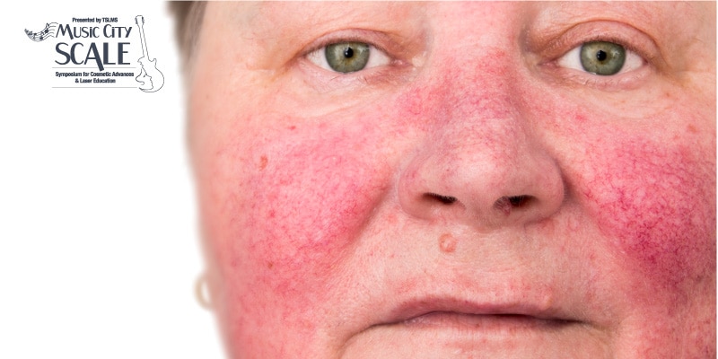 Everything-you-need-to-know-about-Rosacea
