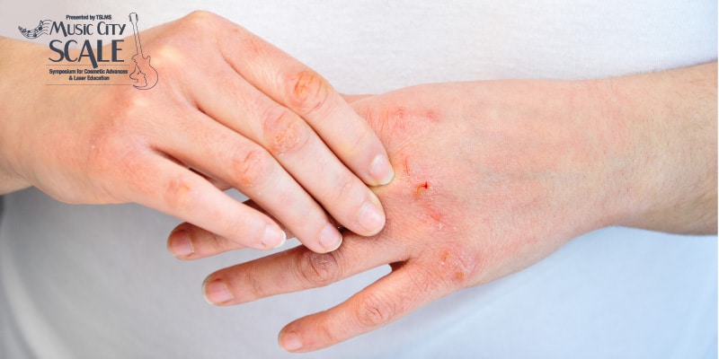 Helping-Clients-Cope-With-Contact-Dermatitis