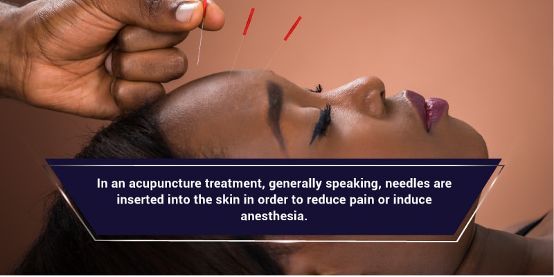 Acupuncture-As-A-Treatment-for-Trigger-Points