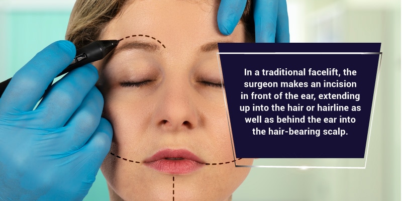 The-FaceLift-Procedure--What-To-Expect