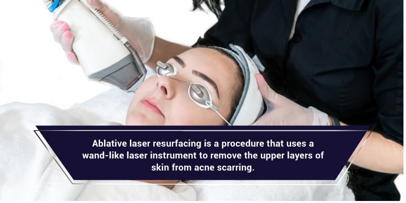 Laser-Treatment-for-Acne-Scars-