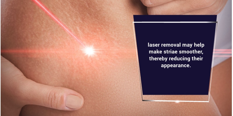 Laser-and-Light-Treatment-for-Stretch-Marks